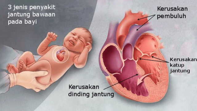 Kenali Penyakit Jantung Bawaan dan Cara Tepat Penanganan